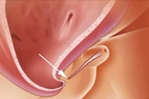 5 dấu hiệu lỗ tiểu thấp ở trẻ không thể bỏ qua