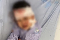 Bé trai ở Lào Cai bị chó cắn lộ xương sọ