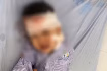 Bé trai ở Lào Cai bị chó cắn lộ xương sọ