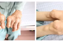 Người đàn ông bị biến dạng khớp, vận động khó do tự điều trị gout tại nhà