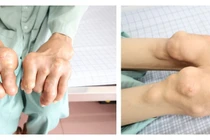 Người đàn ông bị biến dạng khớp, vận động khó do tự điều trị gout tại nhà