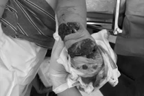 Chấn thương nặng do sơ suất khi vệ sinh máy xay thịt