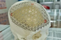 Kỹ thuật vá sọ 3D Titanium giúp bệnh nhân khuyết sọ hồi phục toàn diện