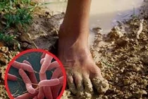 Sốt 2 tháng không khỏi, người đàn ông 60 tuổi đi khám phát hiện mắc whitmore