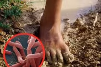 Sốt 2 tháng không khỏi, người đàn ông 60 tuổi đi khám phát hiện mắc whitmore