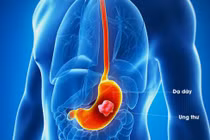 Ca phẫu thuật cho bệnh nhân ung thư dạ dày kết hợp 'sửa' dị tật bẩm sinh