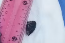 Hy hữu, hạt hồng xiêm nằm trong phế quản người bệnh hơn 10 năm