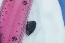 Hy hữu, hạt hồng xiêm nằm trong phế quản người bệnh hơn 10 năm