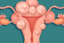 Bóc tách thành công 19 khối u xơ tử cung của một bệnh nhân nữ