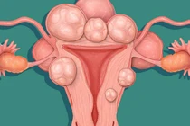 Bóc tách thành công 19 khối u xơ tử cung của một bệnh nhân nữ