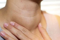 Phẫu thuật thành công ca bướu giáp lớn đe dọa tính mạng cụ bà 90 tuổi