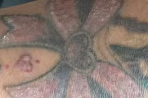 Bác sĩ da liễu cảnh báo trào lưu “họa da” trong giới trẻ