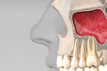 Viêm xoang do răng, nguyên nhân ít ngờ gây đau đầu kéo dài