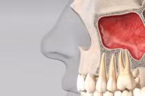 Viêm xoang do răng, nguyên nhân ít ngờ gây đau đầu kéo dài