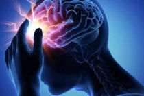 Phẫu thuật giúp người phụ nữ thoát khỏi nỗi đau nửa đầu kéo dài 20 năm