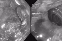 Người đàn ông đi khám bất ngờ phát hiện ung thư dạ dày di căn 