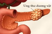 Xu hướng trẻ hóa ung thư dương vật gây lo ngại ở nam giới Việt Nam