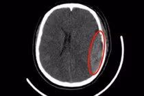 Phẫu thuật cứu sống nữ sinh chấn thương sọ não do tà áo dài quấn vào bánh xe 