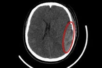 Phẫu thuật cứu sống nữ sinh chấn thương sọ não do tà áo dài quấn vào bánh xe 