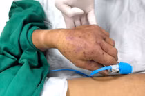 Nam thanh niên suýt mất mạng vì thói quen thích ăn lòng lợn, nem chua