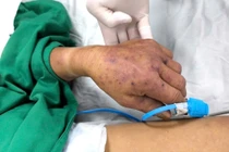 Nam thanh niên suýt mất mạng vì thói quen thích ăn lòng lợn, nem chua