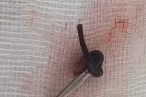 Vắt ký sinh trong mũi cô gái 21 tuổi gây nguy hiểm 