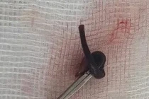 Vắt ký sinh trong mũi cô gái 21 tuổi gây nguy hiểm 