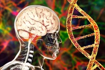 Sốc: Dị tật bẩm sinh não có thể do ADN người Neanderthal