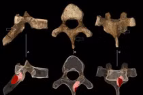 Ung thư cổ xưa nhất ghi nhận từ 1,7 triệu năm trước trong loài người cổ đại