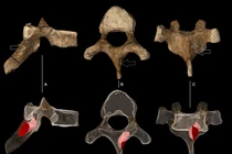 Ung thư cổ xưa nhất ghi nhận từ 1,7 triệu năm trước trong loài người cổ đại