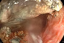 Bé 3 tuổi bị bỏng thực quản vì nuốt pin cúc áo
