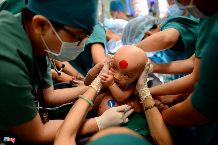 tach cap song sinh dinh lien, anh 2