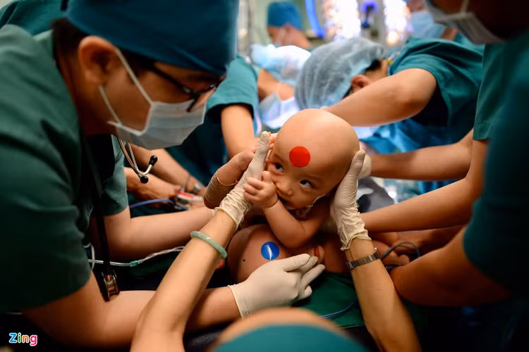 tach cap song sinh dinh lien, anh 2