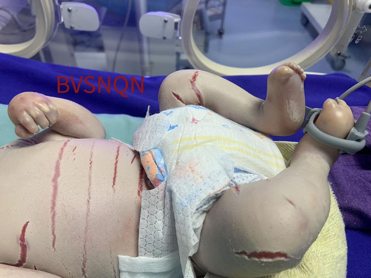 Bé trai sinh non mắc bệnh hiếm gặp, màng trắng bao bọc toàn thân - 2