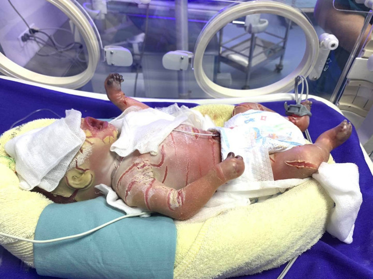 Bé trai sinh non mắc bệnh hiếm gặp, màng trắng bao bọc toàn thân - 1