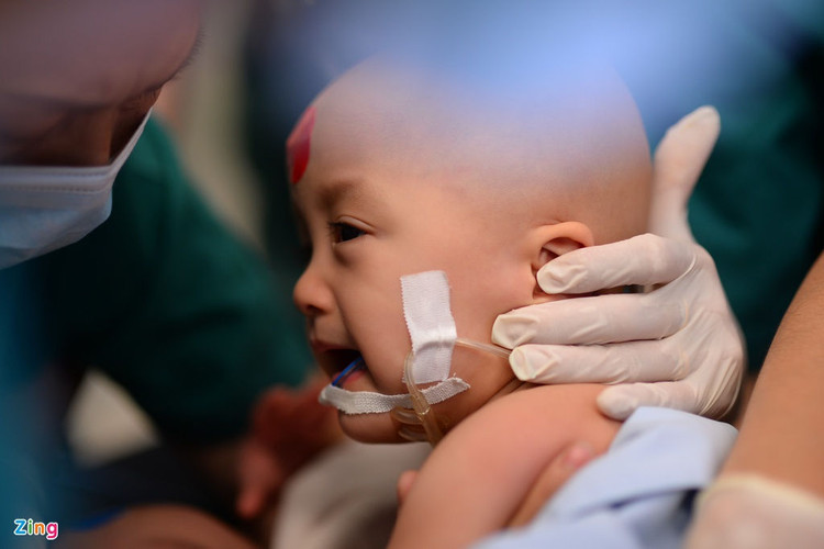 tach song sinh dinh lien anh 2