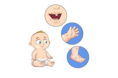 Trẻ nhỏ là đối tượng dễ bị virus tay chân miệng tấn công.