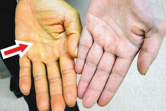 Chế độ ăn uống phản khoa học gây ung thư gan như thế nào? - 4