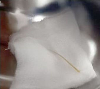 Xương cá dài 6 cm được lấy ra từ tá tràng.