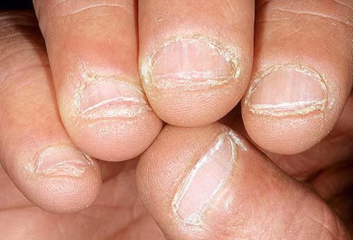 Bất thường trên móng tay tiết lộ sức khỏe của bạn
