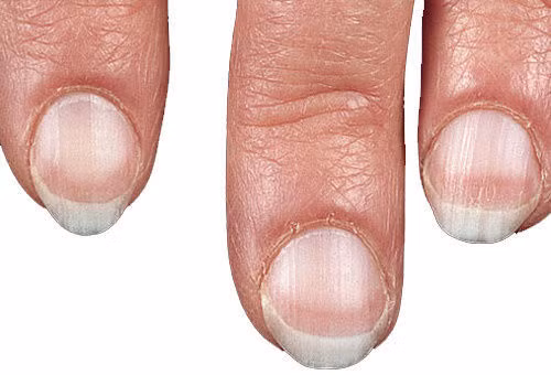 Bất thường trên móng tay tiết lộ sức khỏe của bạn