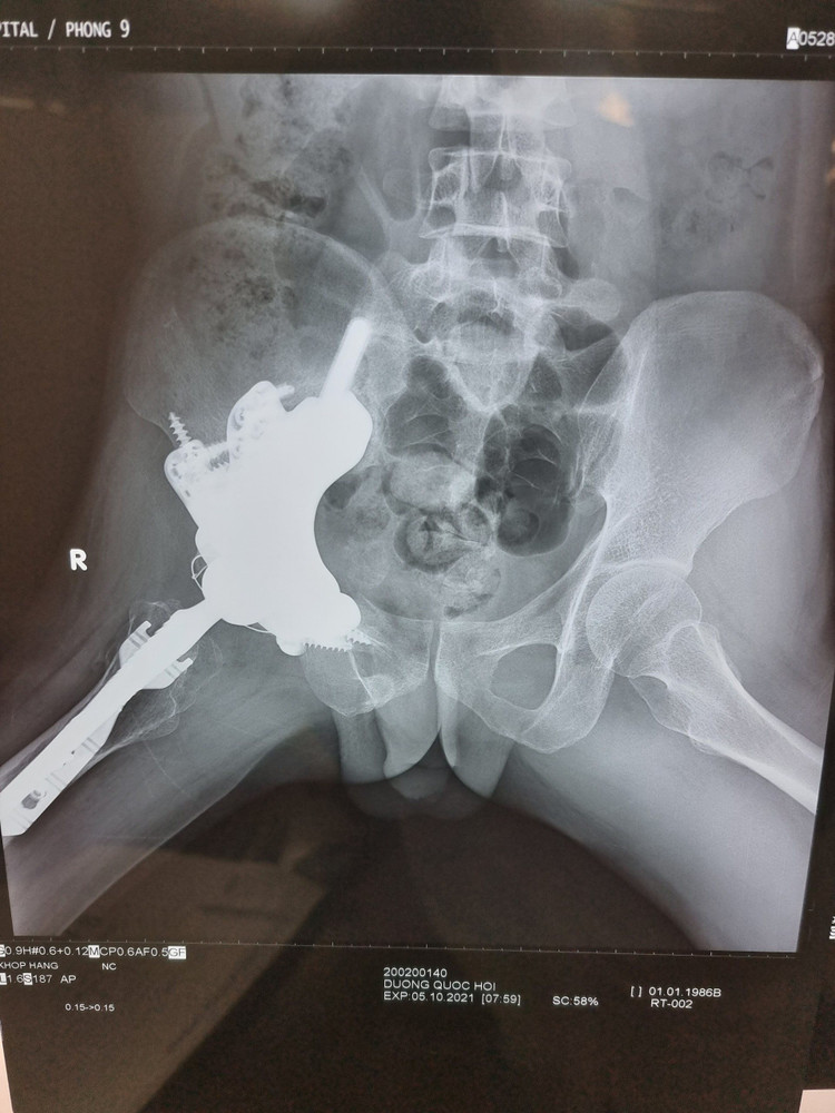 x-quang-sau-mo-3-thang.jpg