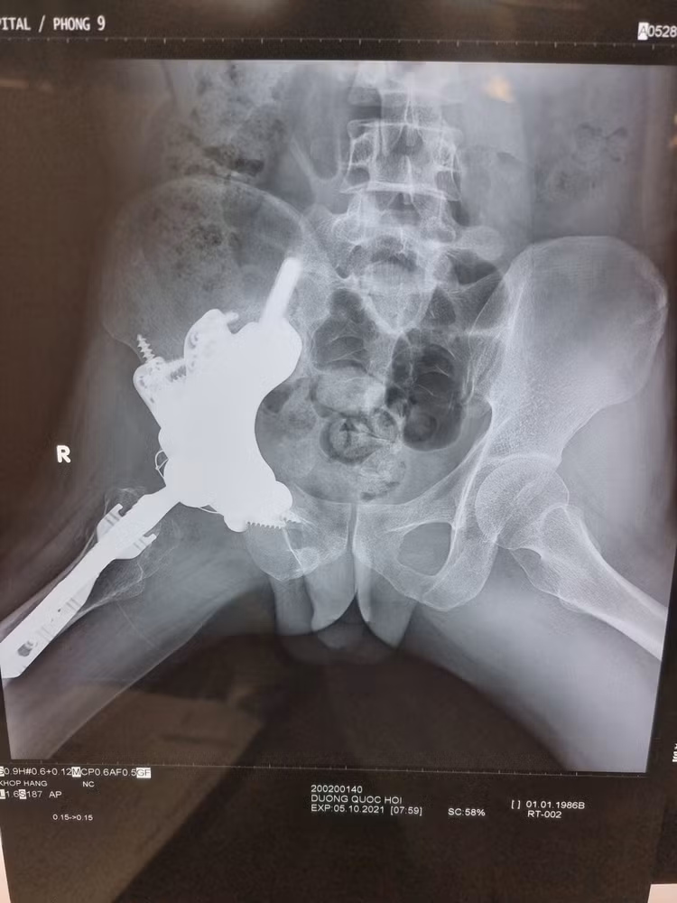 x-quang-sau-mo-3-thang.jpg