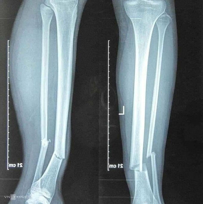 Kết quả chụp chiếu cho thấy mức độ nghiêm trọng ở chân phải của Hùng Dũng.