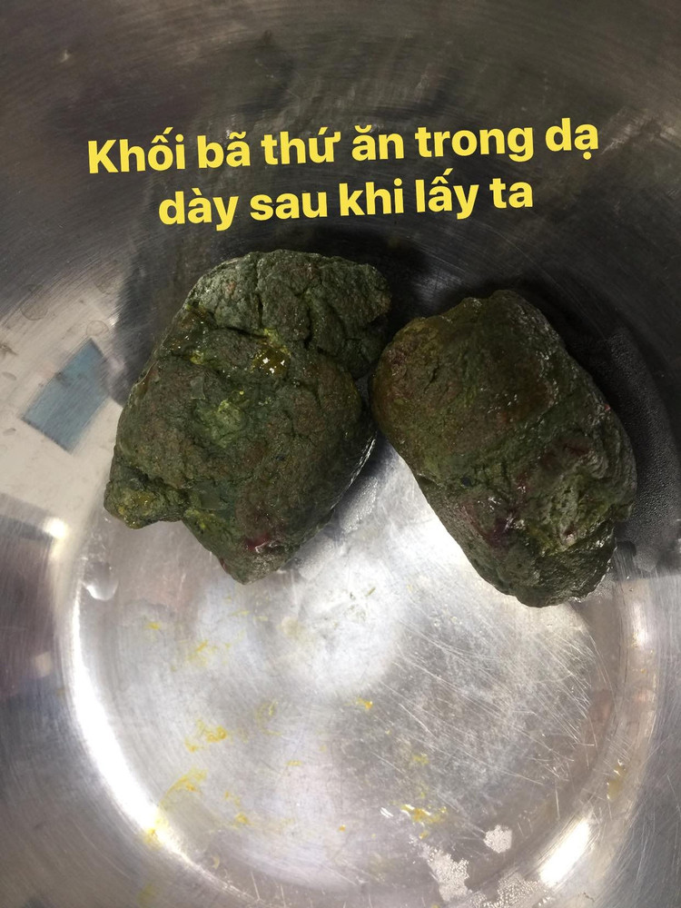 tac-ruot-do-hong-2-khoi-ba-thuc-an-trong-da-day.jpg