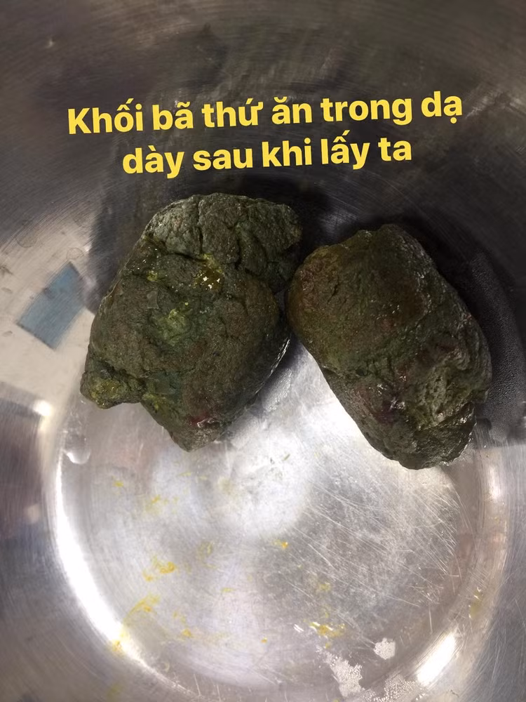 tac-ruot-do-hong-2-khoi-ba-thuc-an-trong-da-day.jpg
