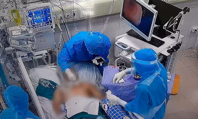 Bác sĩ khoa ICU can thiệp nội soi phế quản cho bệnh nhân ECMO, ngày 9/6. Ảnh: BVCC.