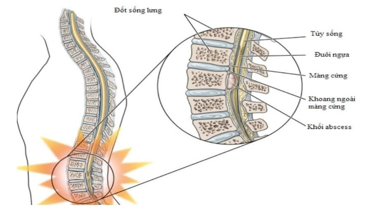 Viêm tủy xương.
