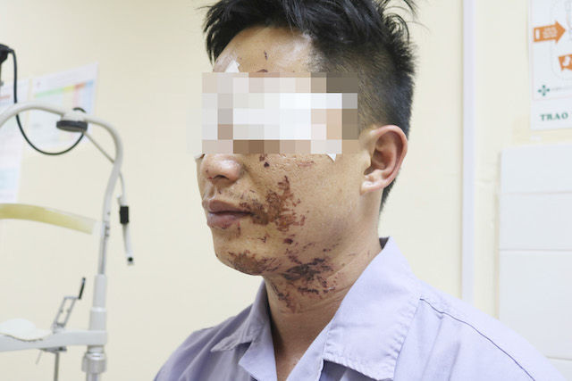 Nổ bình ga khi ăn lẩu người đàn ông bỏng vùng mặt ảnh 1