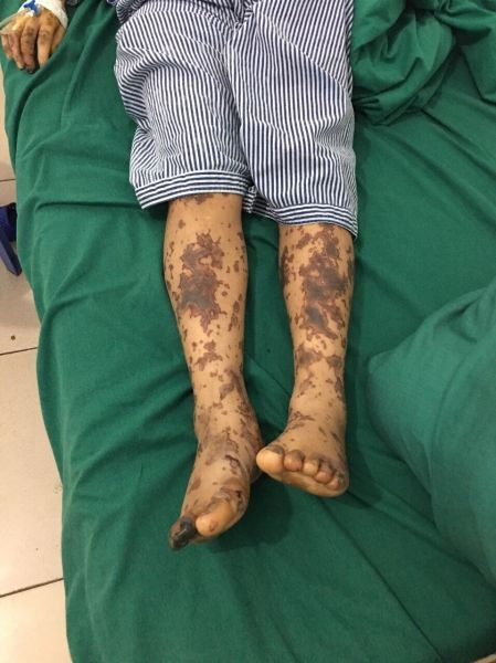 Bàn chân của người mắc bệnh liên cầu lợn. Ảnh: Sở Y tế Hà Giang.